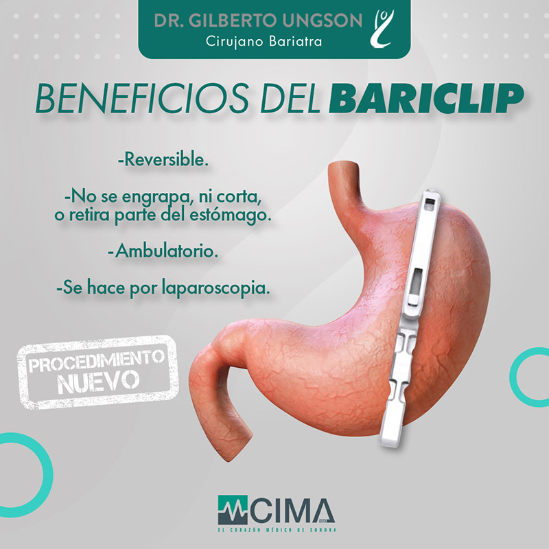 Bariclip - Dr Ungson