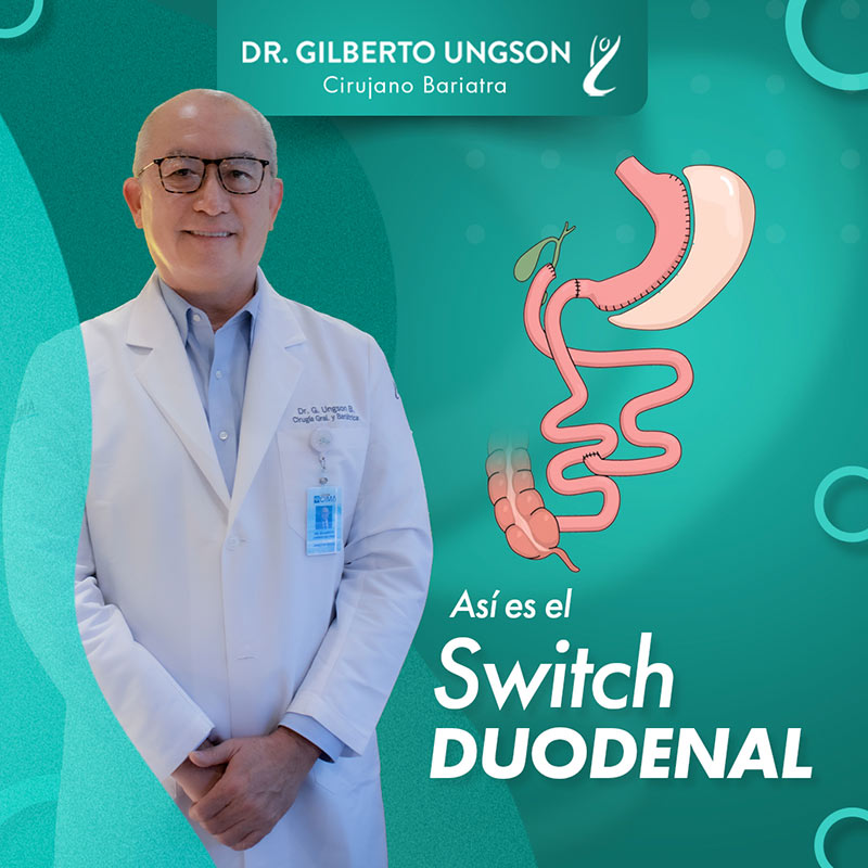 Switch Duodenal